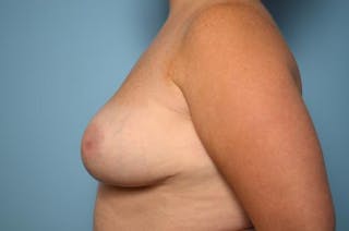 Breast Reduction Before & After Gallery - Patient 355799 - Image 10