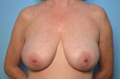 Breast Reduction Before & After Gallery - Patient 377224 - Image 1