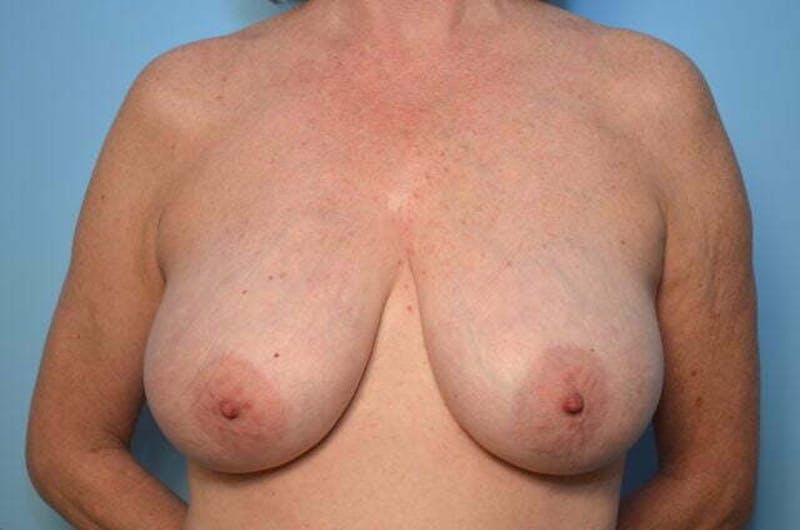 Breast Reduction Before & After Gallery - Patient 377224 - Image 1