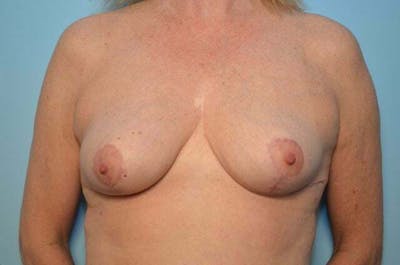 Breast Reduction Before & After Gallery - Patient 377224 - Image 2