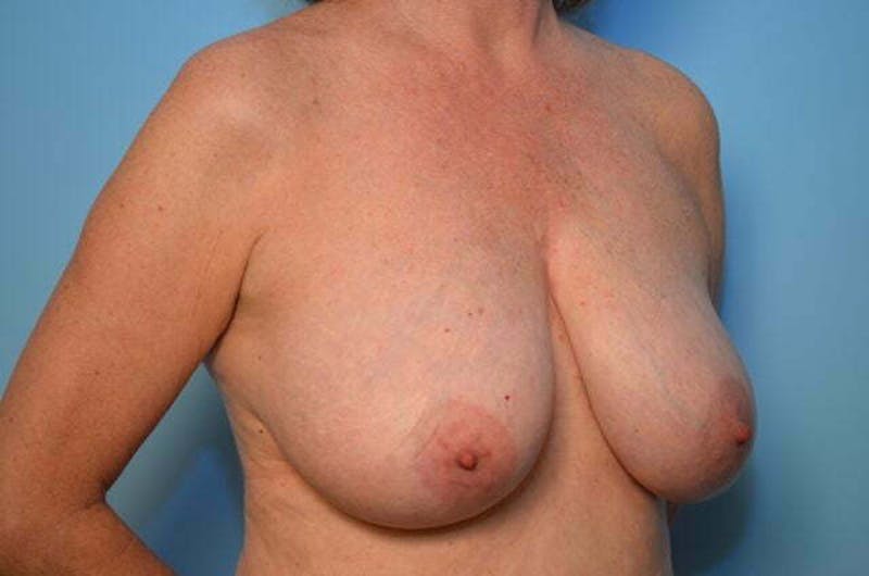 Breast Reduction Before & After Gallery - Patient 377224 - Image 3