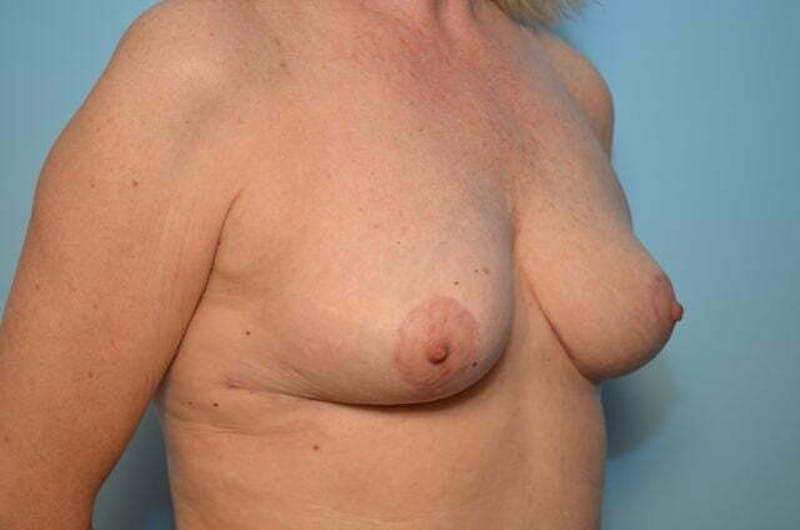 Breast Reduction Before & After Gallery - Patient 377224 - Image 4