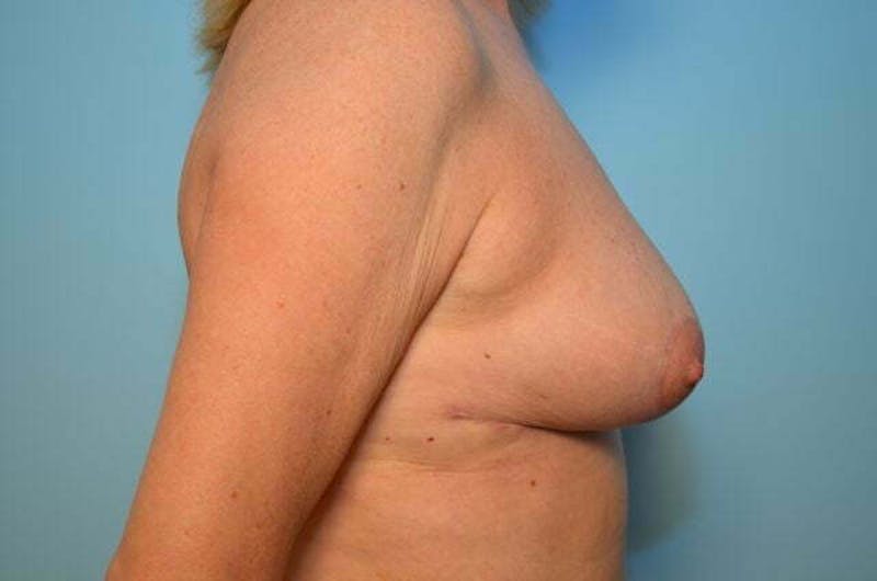 Breast Reduction Before & After Gallery - Patient 377224 - Image 6