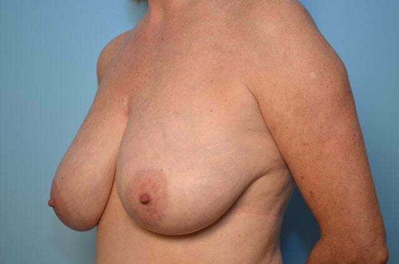 Breast Reduction Before & After Gallery - Patient 377224 - Image 7