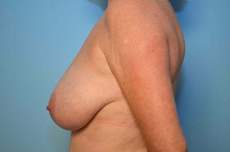 Breast Reduction Before & After Gallery - Patient 377224 - Image 9