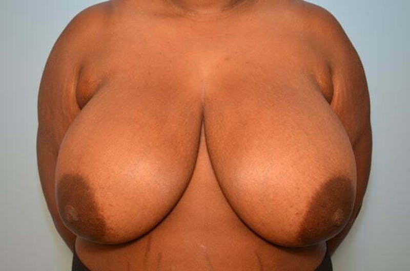 Breast Reduction Before & After Gallery - Patient 334862 - Image 1