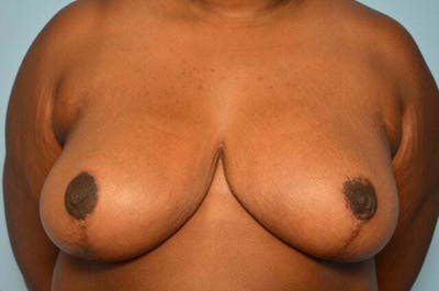 Breast Reduction Before & After Gallery - Patient 334862 - Image 2