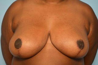 Breast Reduction Before & After Gallery - Patient 135767 - Image 2