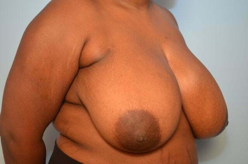 Breast Reduction Before & After Gallery - Patient 334862 - Image 3