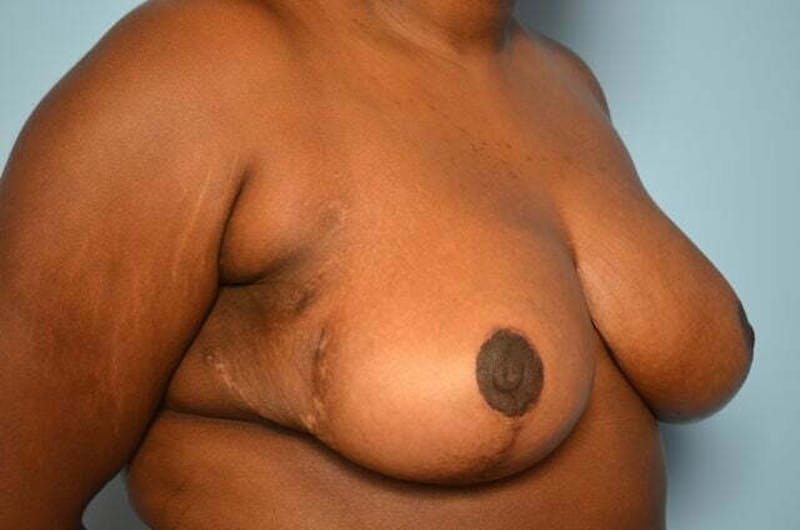 Breast Reduction Before & After Gallery - Patient 334862 - Image 4