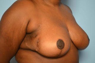 Breast Reduction Before & After Gallery - Patient 135767 - Image 4
