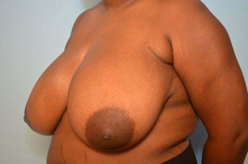 Breast Reduction Before & After Gallery - Patient 334862 - Image 7