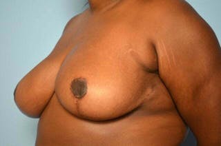 Breast Reduction Before & After Gallery - Patient 135767 - Image 8