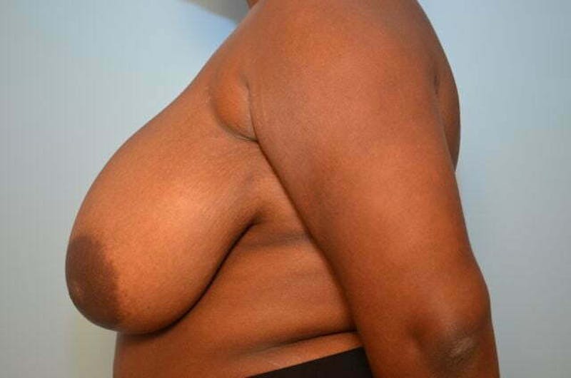 Breast Reduction Before & After Gallery - Patient 334862 - Image 9