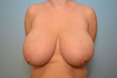 Breast Reduction Before & After Gallery - Patient 224388 - Image 1