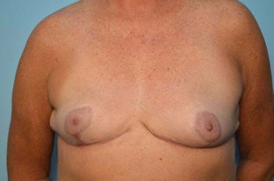 Breast Reduction Before & After Gallery - Patient 405468 - Image 2