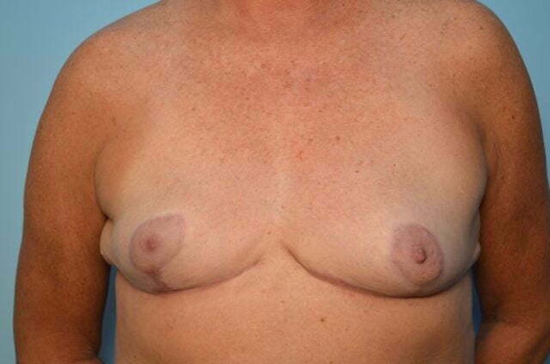 Breast Reduction Before & After Gallery - Patient 405468 - Image 2