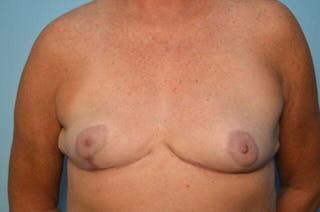 Breast Reduction Before & After Gallery - Patient 419099 - Image 2