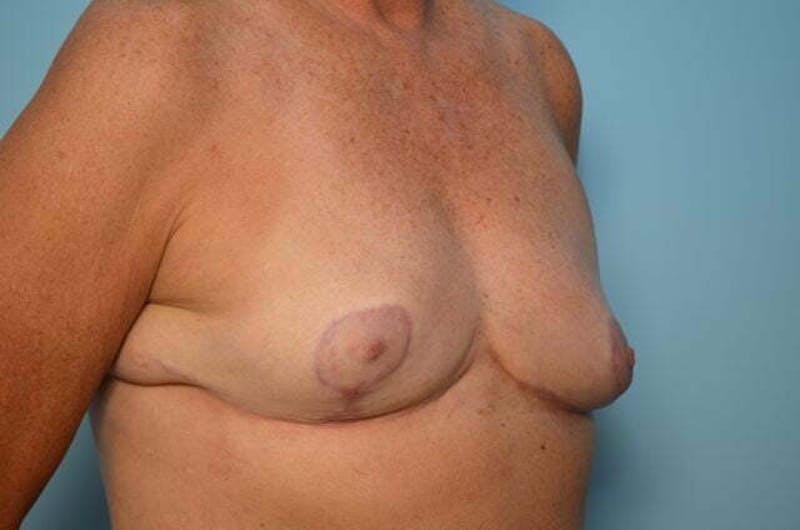 Breast Reduction Before & After Gallery - Patient 405468 - Image 4