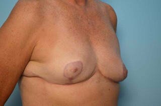 Breast Reduction Before & After Gallery - Patient 419099 - Image 4