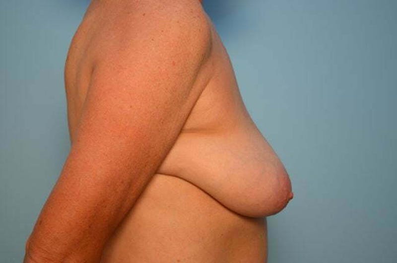 Breast Reduction Before & After Gallery - Patient 405468 - Image 5