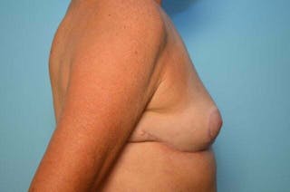 Breast Reduction Before & After Gallery - Patient 419099 - Image 6