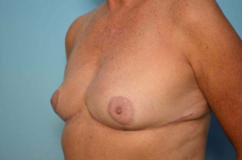 Breast Reduction Before & After Gallery - Patient 405468 - Image 8