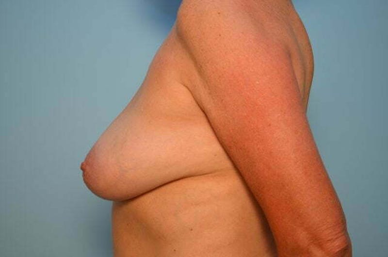 Breast Reduction Before & After Gallery - Patient 405468 - Image 9