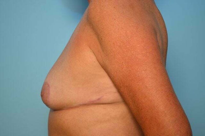 Breast Reduction Before & After Gallery - Patient 405468 - Image 10