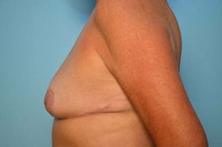 Breast Reduction Before & After Gallery - Patient 419099 - Image 10
