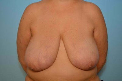 Breast Reduction Before & After Gallery - Patient 888718 - Image 1