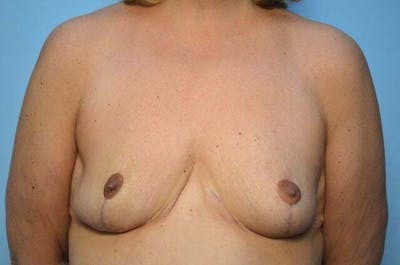 Breast Reduction Before & After Gallery - Patient 888718 - Image 2