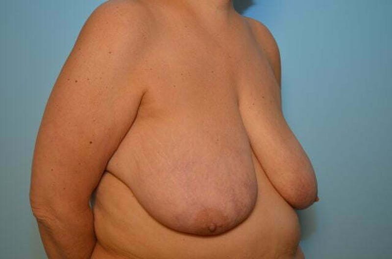 Breast Reduction Before & After Gallery - Patient 888718 - Image 3