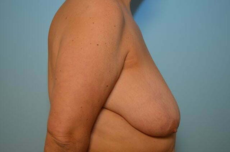 Breast Reduction Before & After Gallery - Patient 888718 - Image 5