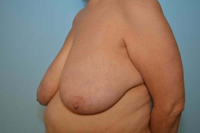 Breast Reduction Before & After Gallery - Patient 888718 - Image 7