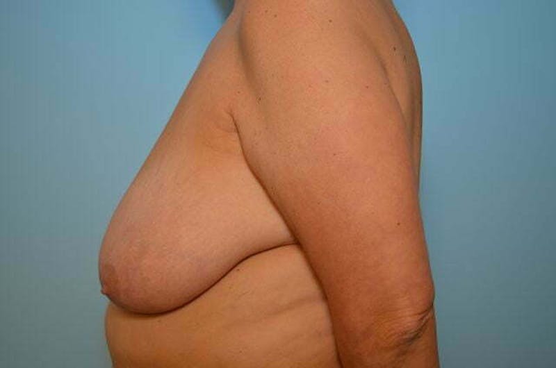 Breast Reduction Before & After Gallery - Patient 888718 - Image 9