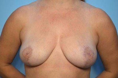 Breast Reduction Before & After Gallery - Patient 908548 - Image 2