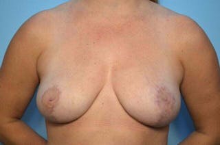 Breast Reduction Before & After Gallery - Patient 482028 - Image 2