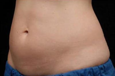 CoolSculpting Before & After Gallery - Patient 182390 - Image 1