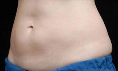 CoolSculpting Before & After Gallery - Patient 182390 - Image 2