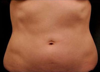 CoolSculpting Before & After Gallery - Patient 412388 - Image 1