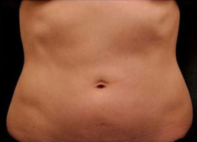 CoolSculpting Before & After Gallery - Patient 412388 - Image 1