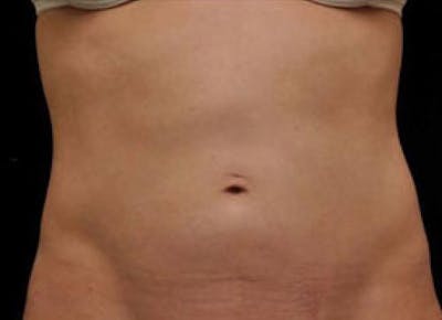 CoolSculpting Before & After Gallery - Patient 412388 - Image 2