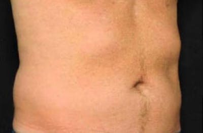 CoolSculpting Before & After Gallery - Patient 416449 - Image 1