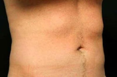 CoolSculpting Before & After Gallery - Patient 416449 - Image 2