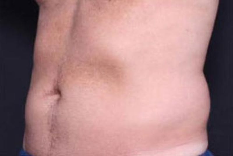 CoolSculpting Before & After Gallery - Patient 416449 - Image 3