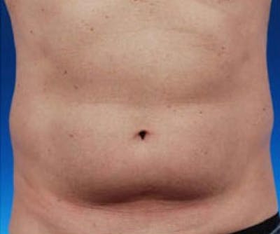 CoolSculpting Before & After Gallery - Patient 487604 - Image 1