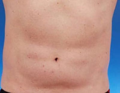 CoolSculpting Before & After Gallery - Patient 487604 - Image 2