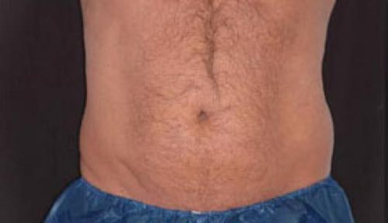 CoolSculpting Before & After Gallery - Patient 281637 - Image 1