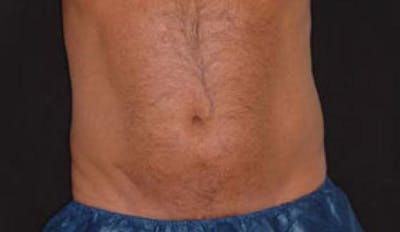 CoolSculpting Before & After Gallery - Patient 281637 - Image 2